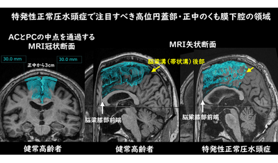 特発性正常圧水頭症（iNPH）を見つけるために重要な所見『高位円蓋部・正中の脳溝の狭小化（THC）』の定義を明瞭化