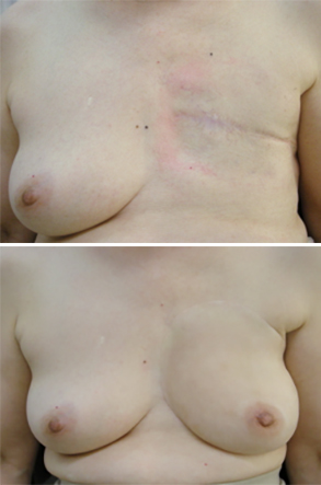 左乳房を全摘後（上の写真）、特殊な接着剤で人工乳房を装着（下の写真）すると手術の傷跡は隠れて見えない（川村義肢株式会社「工房アルテ」提供）