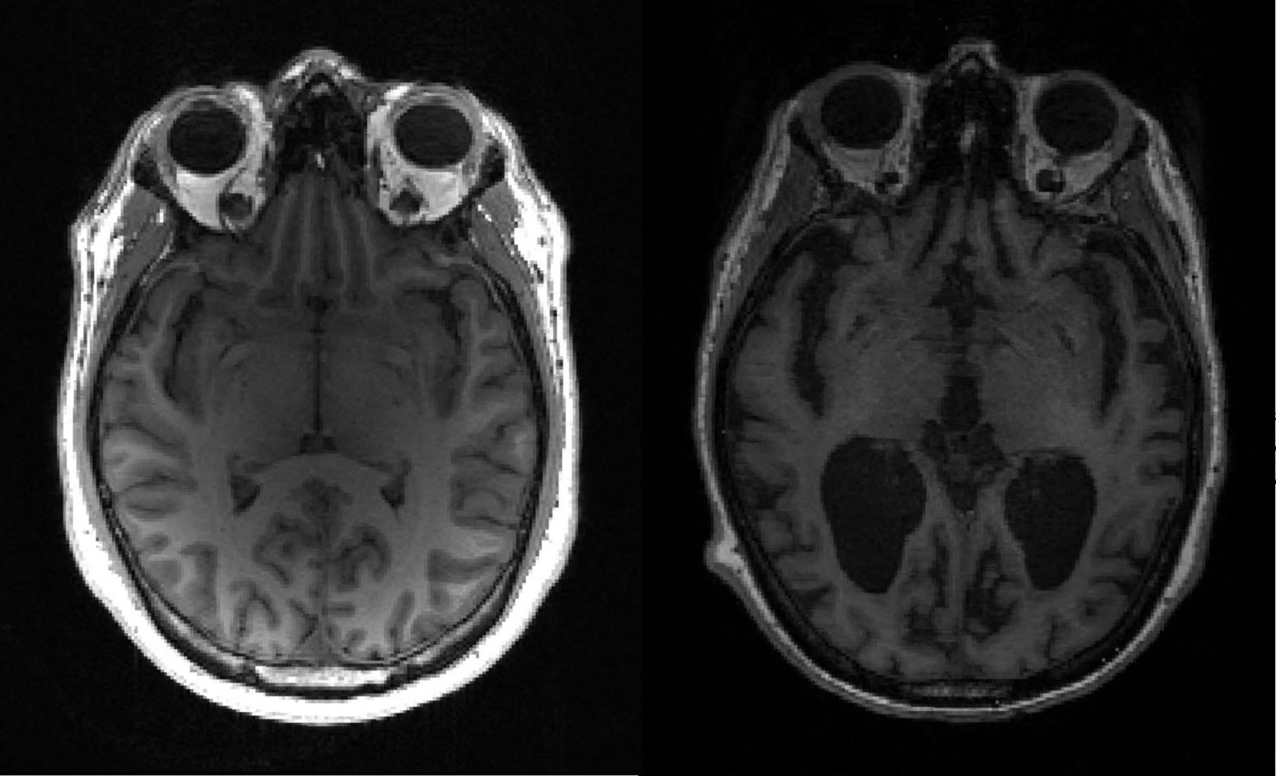 健康な脳（左）とアルツハイマーの脳（右）のMRI画像＝AFP時事