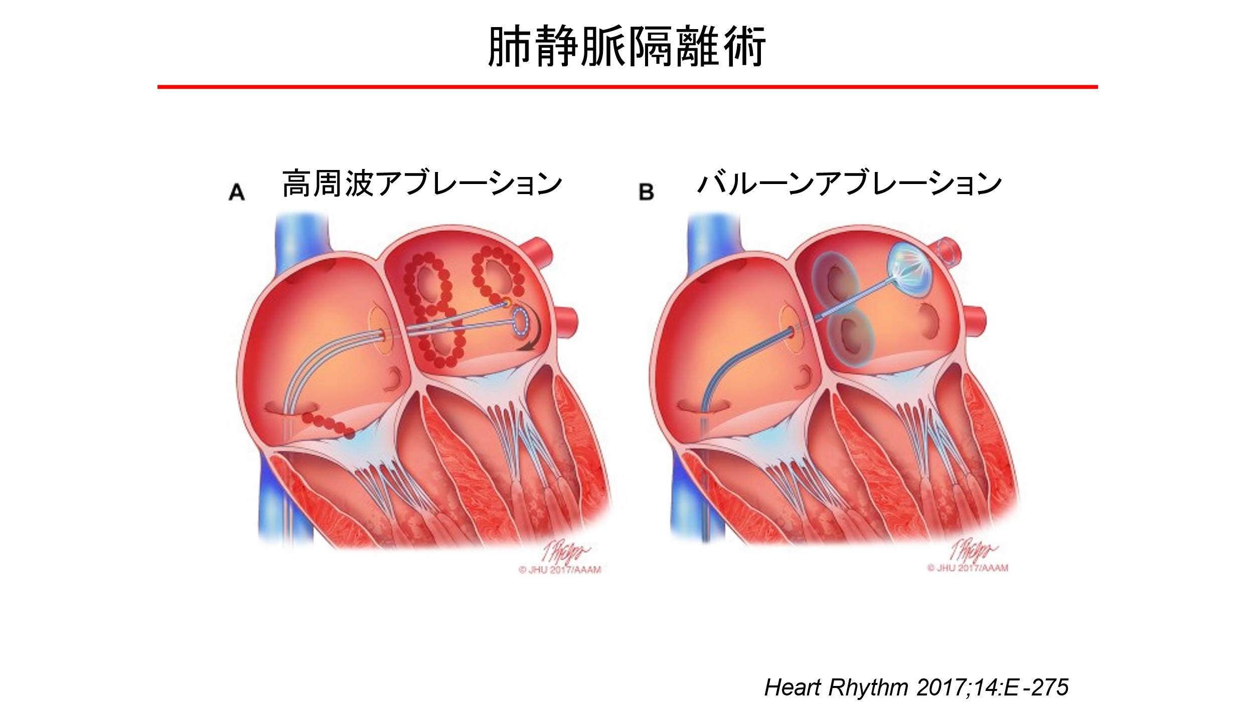 肺静脈で起きた異常な電気信号が左心房に入らないように肺静脈の開口部周辺の4本の肺静脈を円周状に焼灼する（熊谷浩一郎医師提供）