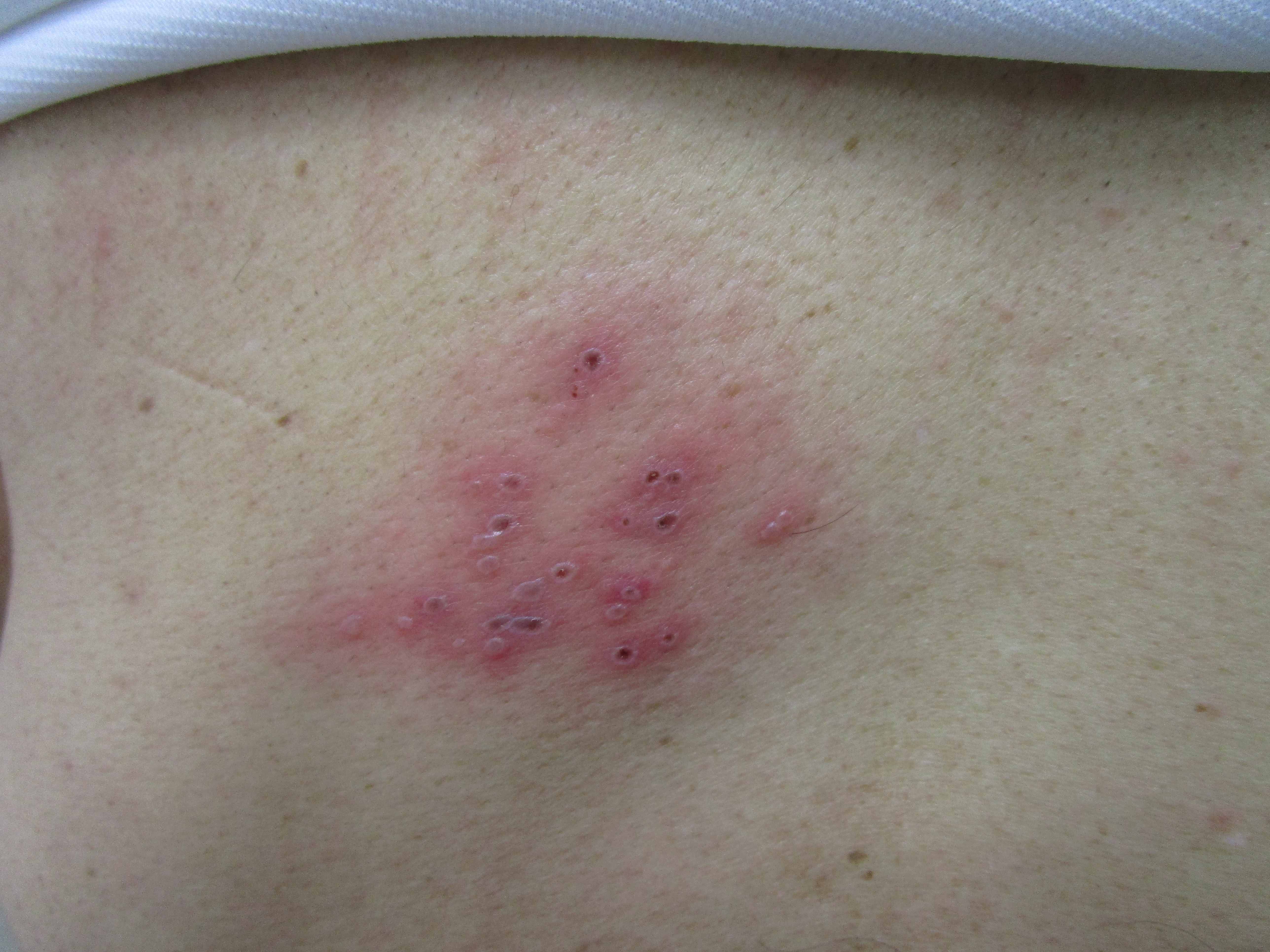 背中にできた帯状疱疹