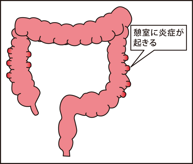 大腸憩室炎