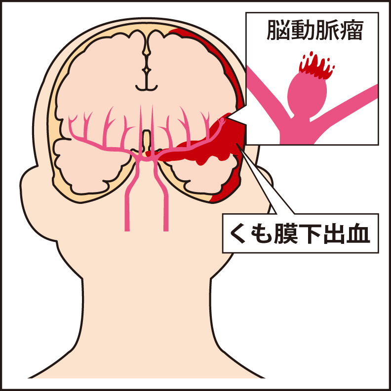 赤い部分はくも膜下出血の様子。血管の分岐部にできた未破裂脳動脈瘤が破裂した様子（右上）