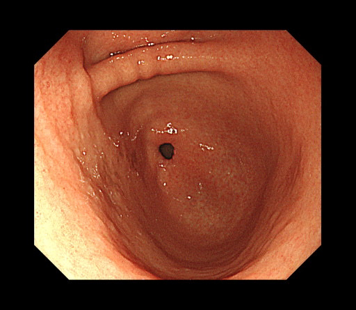 萎縮性胃炎と診断された際の画像。胃の粘膜が薄くなり、血管が透けて見えている（筆者提供）【時事通信社】