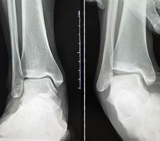捻挫した足首のレントゲン画像。左側は通常の状態だが、右側は捻挫したときの状況を再現したストレス撮影で、靭帯が伸びているのが分かる（足のクリニック表参道提供）
