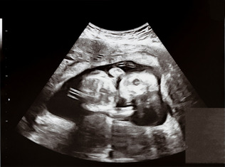 妊娠中期の胎児の超音波エコー写真（資料）