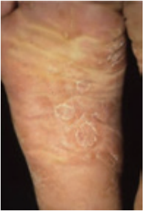 梅毒の第2期症状 足の裏のバラ疹