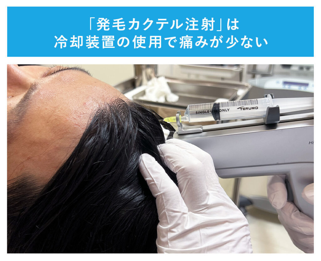 発毛カクテル注射は冷却装置の使用で痛みが少ない