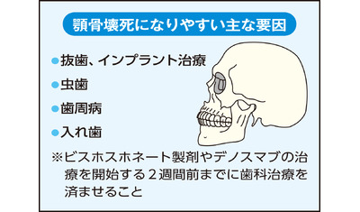 骨粗しょう症治療薬の副作用抜歯などの後に顎骨壊死