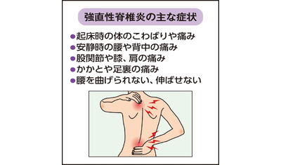 背骨や腰に激痛も男性に多い強直性脊椎炎