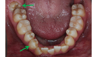 歯を抜かずに症状悪化誤解が多い矯正治療