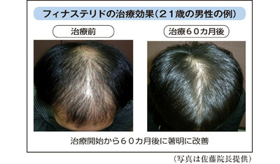 早期治療で改善の可能性男性型脱毛症の薬物治療
