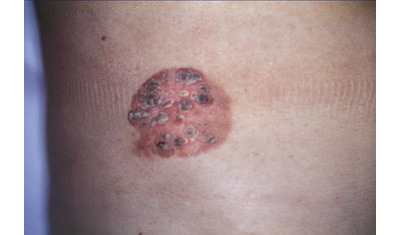 皮膚がんの前段階―ボーエン病早期の手術で再発回避