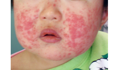 幼児にウイルス性の発疹―ジアノッティ症候群ワクチン接種きっかけに発症も