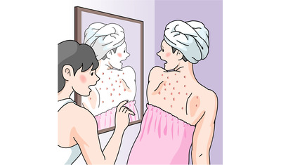 皮膚科で適切な治療を―背中のニキビマラセチア毛包炎との区別がカギ