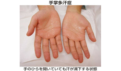 手のひらに大量の汗―手掌多汗症　外用薬、注射薬に加え、手術が選択肢に