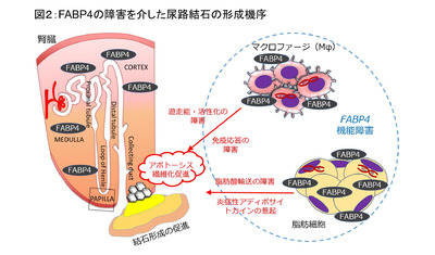 尿路結石の発症に関わる遺伝子を発見-名古屋市立大