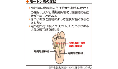 足指の付け根に痛み「モートン病」　圧迫されて神経を刺激