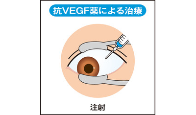 日本人に多い近視性黄斑変性症～早期治療で視力維持も（日本医科大学千葉北総病院眼科　五十嵐勉部長）～