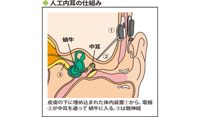 補聴器でも聞き取りにくい～治療手段は人工内耳（九州大学病院耳鼻咽喉・頭頸部外科　中川尚志教授）～