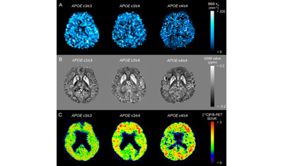 アルツハイマー病の血液脳関門機能障害を画像化