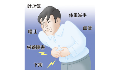消化管に起こる好酸球性胃腸炎～日本人に多く、生活に影響も（国立成育医療研究センター　野村伊知郎室長）～