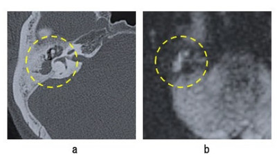 中内耳C T（コンピューター断面撮影）を用いた中耳真珠腫進展範囲に関する人工知能診断システムの作成に世界で初めて成功