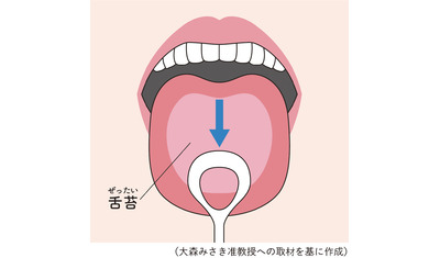 口臭の原因「舌苔」～正しく磨いて予防（日本歯科大学新潟病院　大森みさき准教授）～