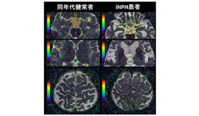脳脊髄液の微細な動きをMRI撮像法IVIMで観測