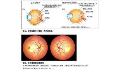 近視性網脈絡膜萎縮症におけるヒト(同種)皮下脂肪組織由来間葉系幹細胞シート（PAL-222）移植の第Ⅰ/Ⅱa相臨床試験（治験）の開始