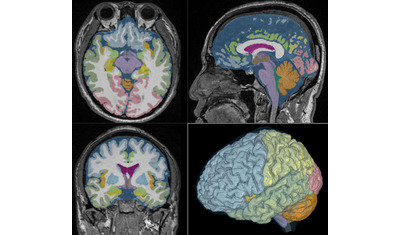 AI（人工知能）を使って、MRIから脳と脳脊髄液を正確に自動領域分割し、脳の老化による環境変化を観測