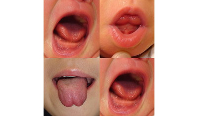 舌小帯短縮症、正しい知識で早期治療～哺乳に支障、切開手術で改善～