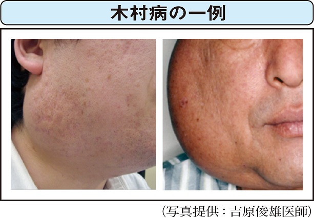 木村病 を知っていますか 青壮年期の男性に多い顔の腫れ 医療ニュース トピックス 時事メディカル 時事通信の医療ニュースサイト