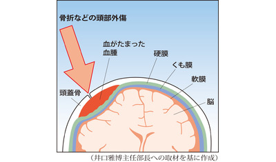 急性硬膜外血腫～直後に意識あっても注意（水戸済生会総合病院　井口雅博主任部長）～