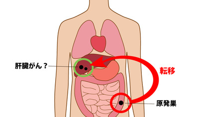 がんの「転移」を患者さんに説明する