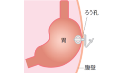 ＱＯＬ維持する胃ろう
～安全性向上、患者の苦痛減少～