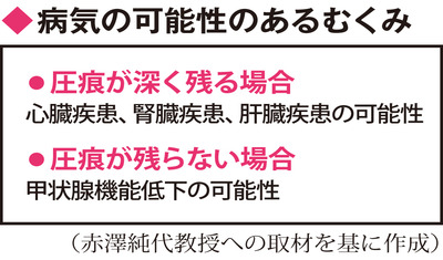 ウオーキング、階段の上り下り～女性のむくみ対策（金沢医科大病院　赤澤純代教授）～