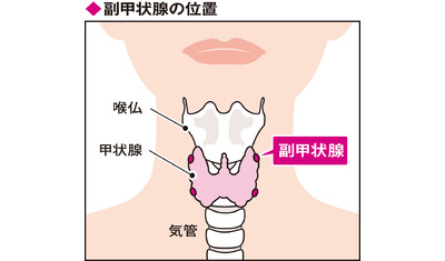 副甲状腺機能低下症～遺伝性は指定難病にも（帝京大ちば総合医療センター　井上大輔病院長）～