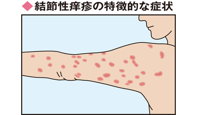 かゆみの強い病変が多発～結節性痒疹（防衛医科大学校病院　佐藤貴浩教授）～