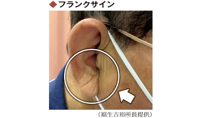 耳たぶに深いしわ
～動脈硬化のサインかも（博慈会記念総合病院付属老人病研究所　福生吉裕所長）～