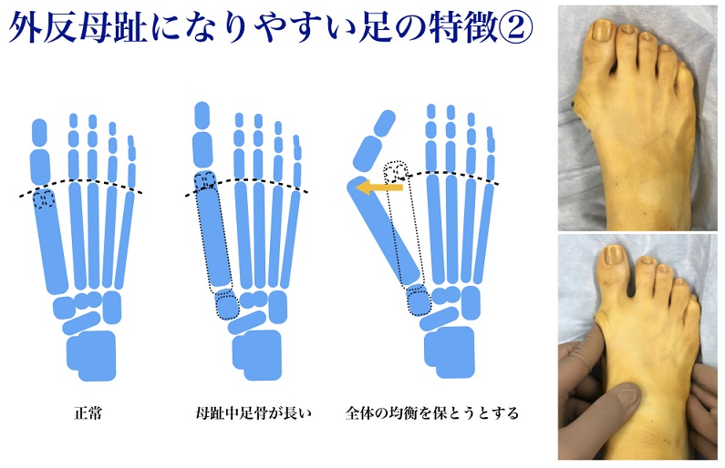 第6回 外反母趾はハイヒールのせいじゃない 実は遺伝の影響が大きいのです 足の悩み 一挙解決 時事メディカル 時事通信の医療ニュースサイト
