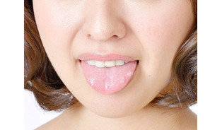 舌のセンサーなどに異常？ ＝早期治療したい味覚障害