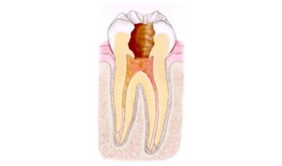 虫歯の進行と処置