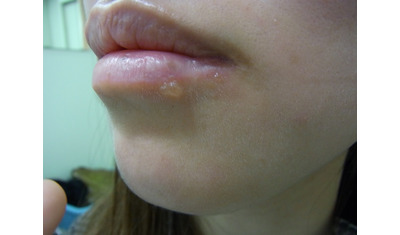 接触で感染する口唇ヘルペス
～唇や周囲に水膨れ～