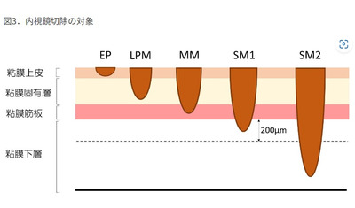 食道がん、内視鏡で治療するケースも