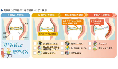 １つでも当てはまったら要注意！～どんな膝の痛みなら病院に行くべき？～