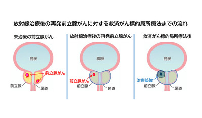 放射線治療後に再発した前立腺がん治療～超音波を用いたHIFUに期待～