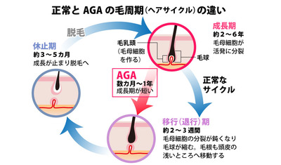 薄毛対策の新常識！～最先端のAGA治療法～