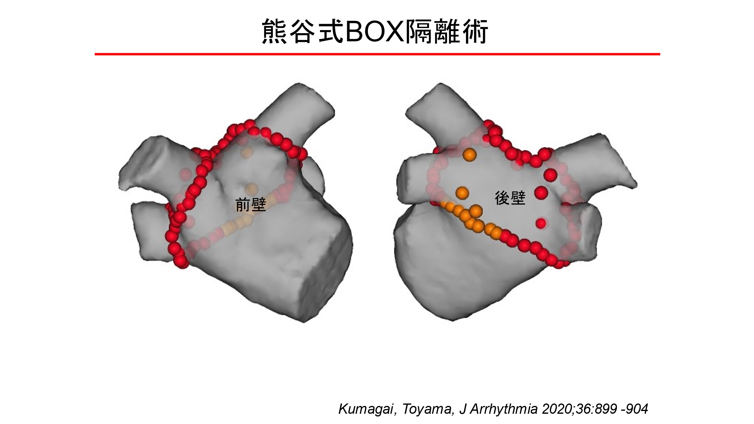 4本の肺静脈と左心房の後壁までBOX（箱）のように広く隔離する（熊谷浩一郎医師提供）