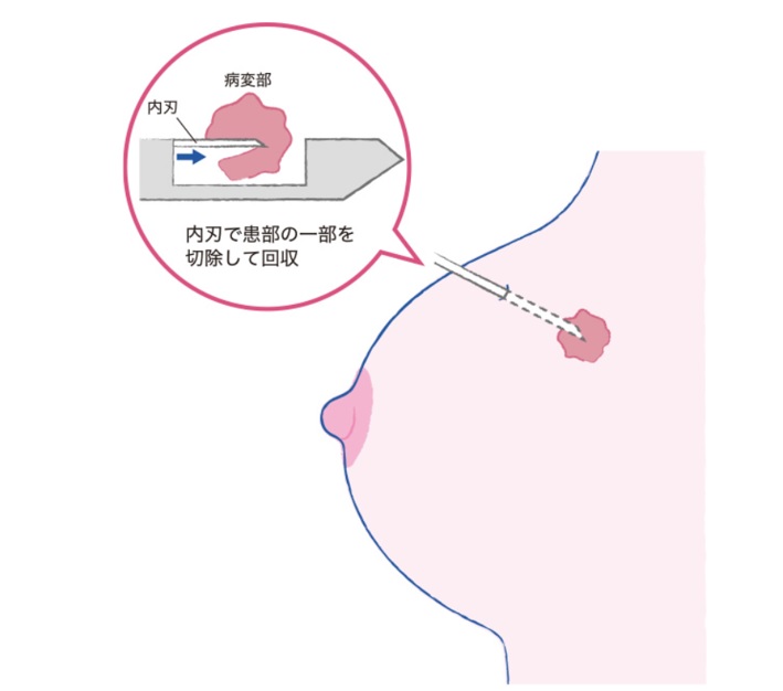 針生検＝中外製薬サイト「おしえて乳がんのコト」（https://oshiete-gan.jp/breast/）より転載